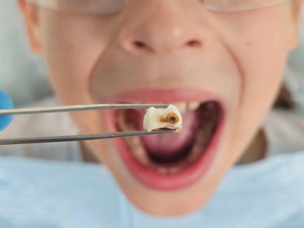 Best Emergency Wisdom Teeth Removal in Helena, OK